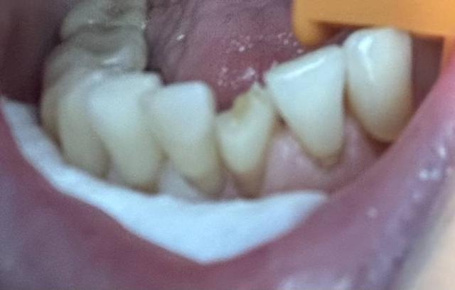 Smile Makeover before at Smile Worth Dental Co. in Fort Worth, TX