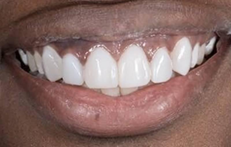 Smile Worth Dental Co. smile makeover after — Fort Worth, TX