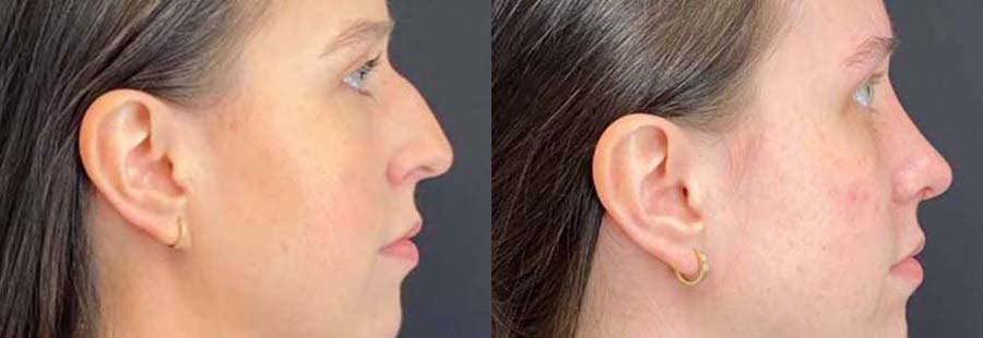 Demetri Arnaoutakis, MD rhinoplasty result — Tampa, FL