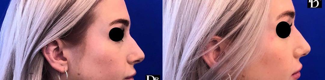 Demetri Arnaoutakis, MD rhinoplasty result — Tampa, FL