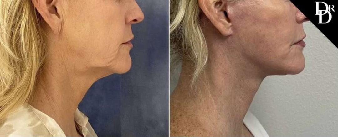 Demetri Arnaoutakis, MD facelift result — Tampa, FL