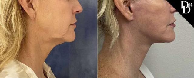 Facelift result at Demetri Arnaoutakis, MD in Tampa, FL