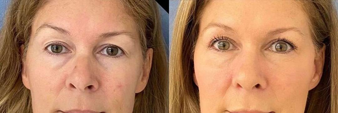 Demetri Arnaoutakis, MD rhinoplasty result — Tampa, FL