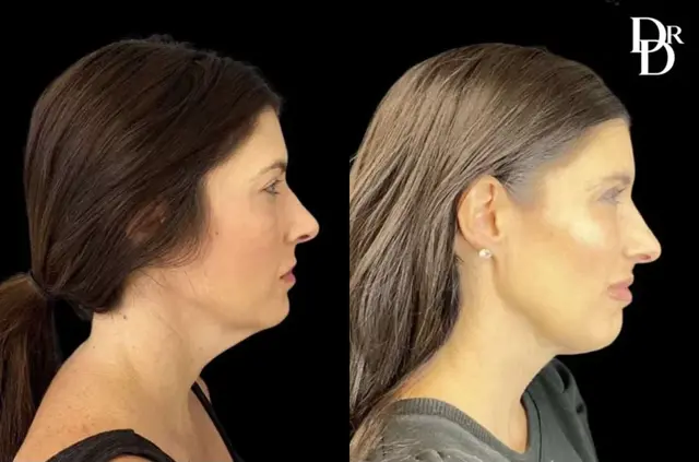 Laser Skin Resurfacing result at Demetri Arnaoutakis, MD in Tampa, FL