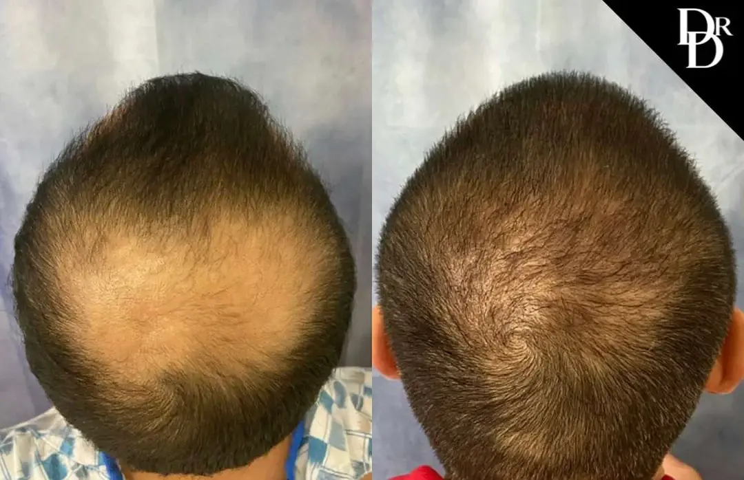 Demetri Arnaoutakis, MD hair restoration result — Tampa, FL