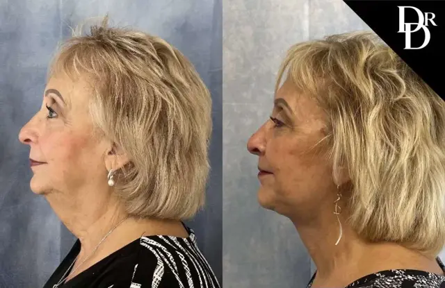 Facelift result at Demetri Arnaoutakis, MD in Tampa, FL