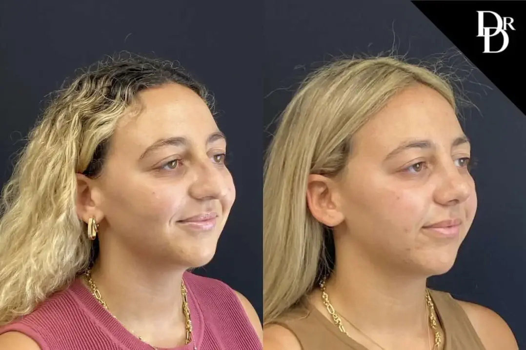 Demetri Arnaoutakis, MD rhinoplasty result — Tampa, FL