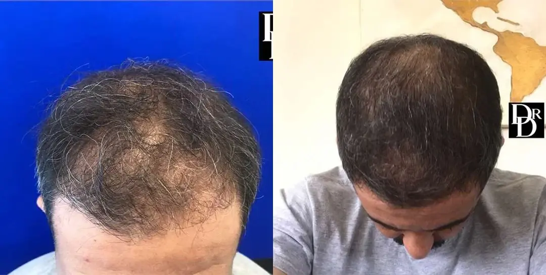 Demetri Arnaoutakis, MD hair restoration result — Tampa, FL
