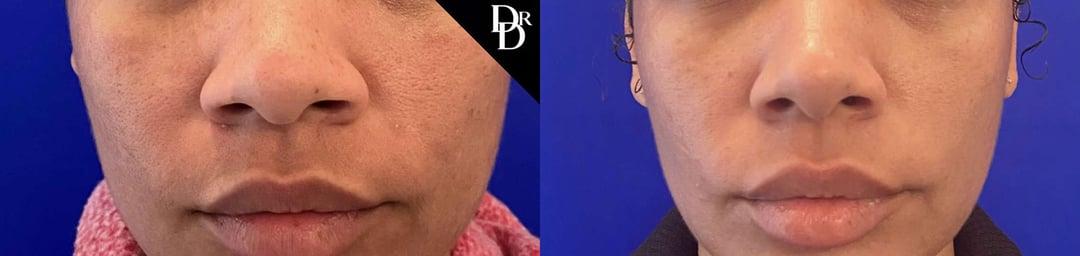 Demetri Arnaoutakis, MD rhinoplasty result — Tampa, FL