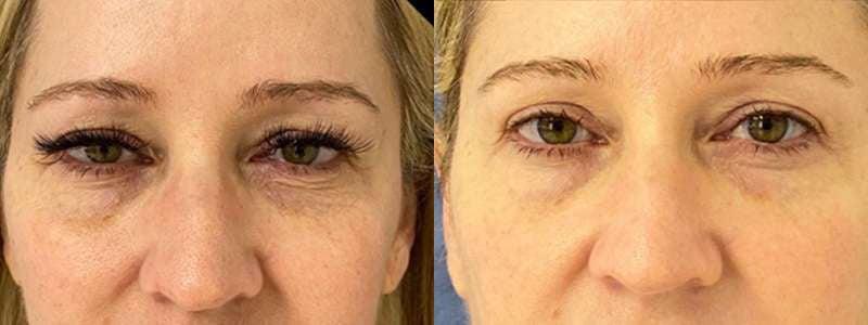 Demetri Arnaoutakis, MD blepharoplasty result — Tampa, FL