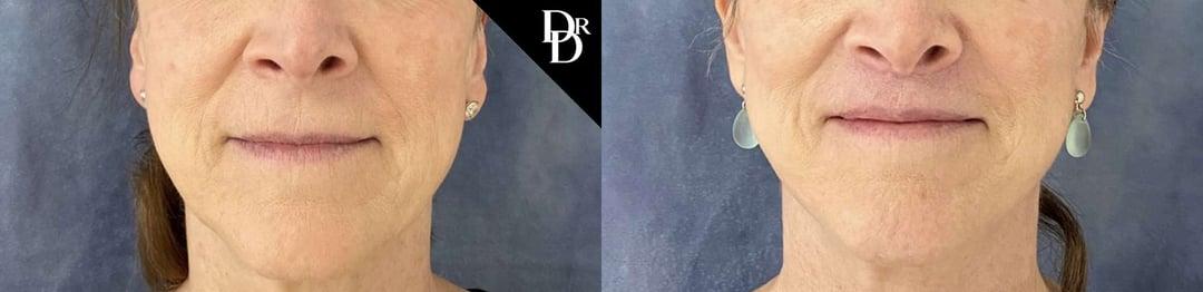 Demetri Arnaoutakis, MD facelift result — Tampa, FL