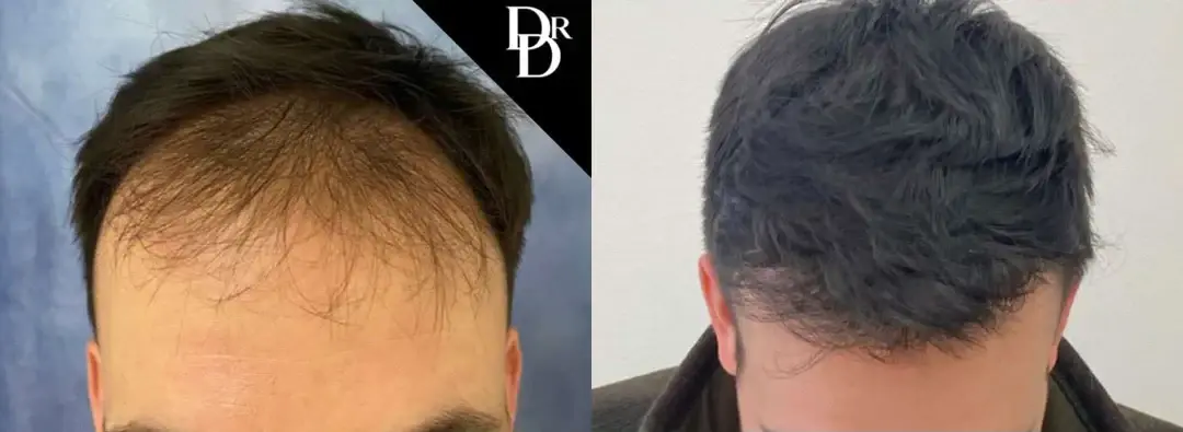 Demetri Arnaoutakis, MD hair restoration result — Tampa, FL