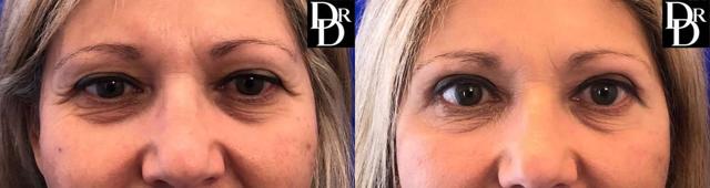 Blepharoplasty result at Demetri Arnaoutakis, MD in Tampa, FL