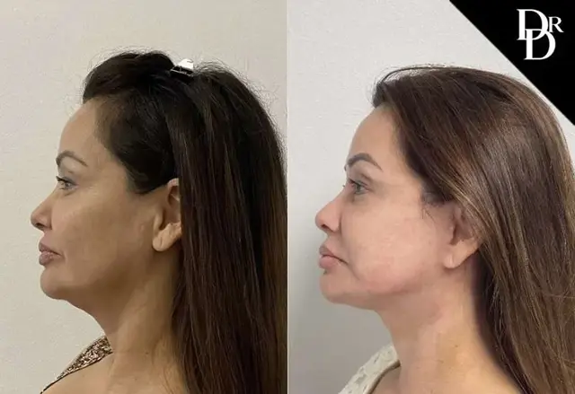 Facelift result at Demetri Arnaoutakis, MD in Tampa, FL