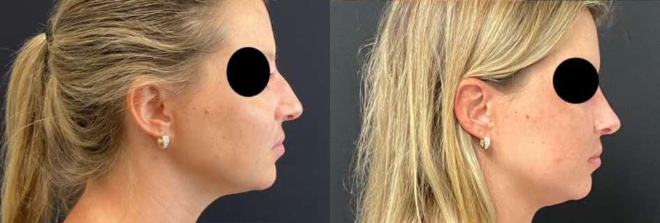 Demetri Arnaoutakis, MD rhinoplasty result — Tampa, FL