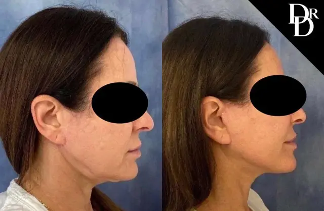 Facelift result at Demetri Arnaoutakis, MD in Tampa, FL
