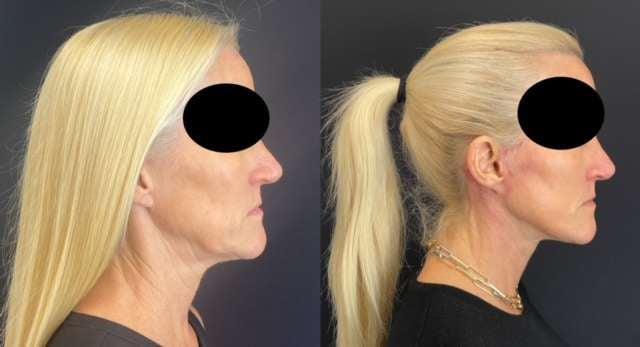 Facelift result at Demetri Arnaoutakis, MD in Tampa, FL