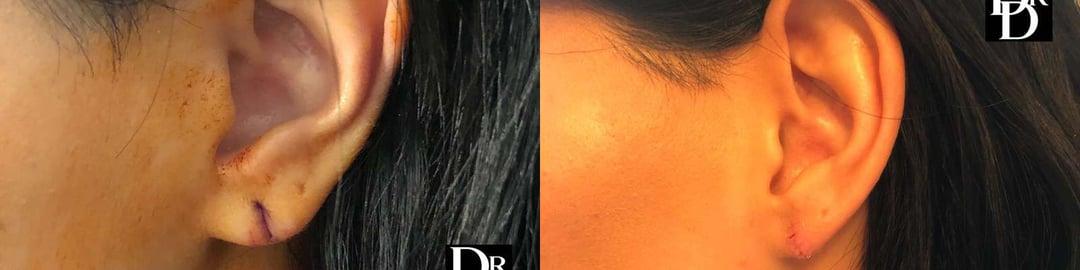 Demetri Arnaoutakis, MD facelift result — Tampa, FL