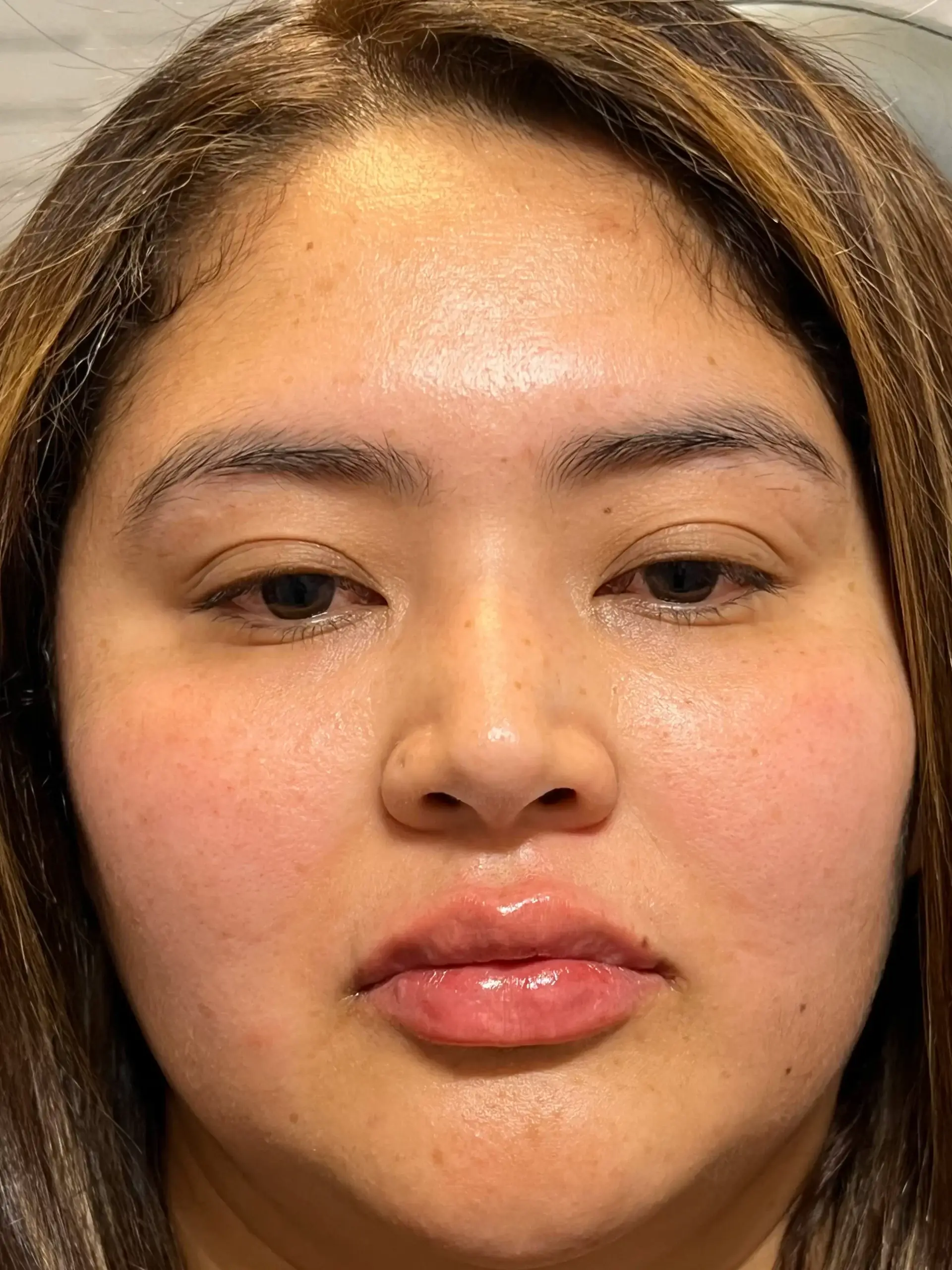 Urban Medspa & Weight Loss Center lip filler after — Charlotte, NC