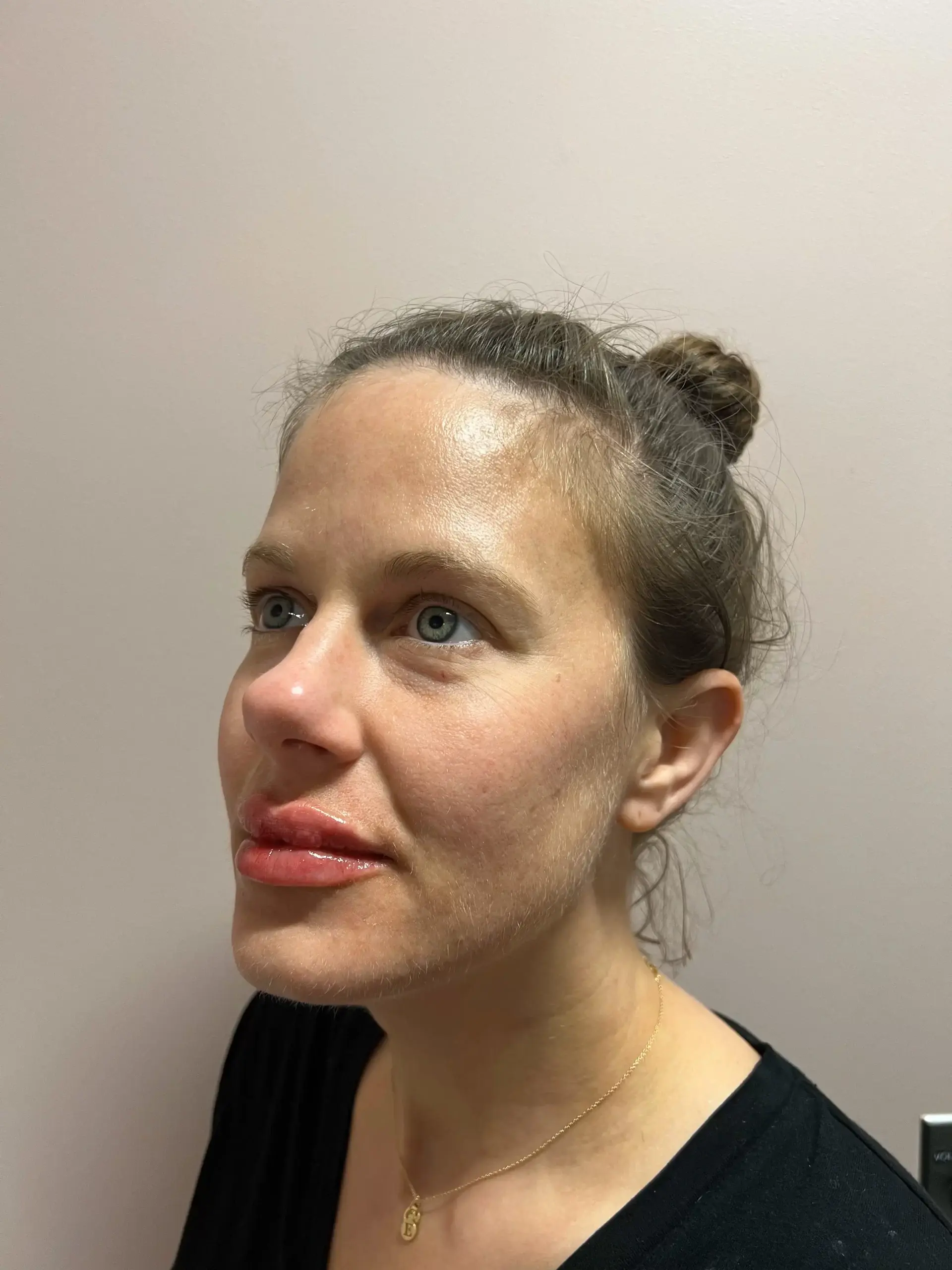 Urban Medspa & Weight Loss Center lip filler after — Charlotte, NC