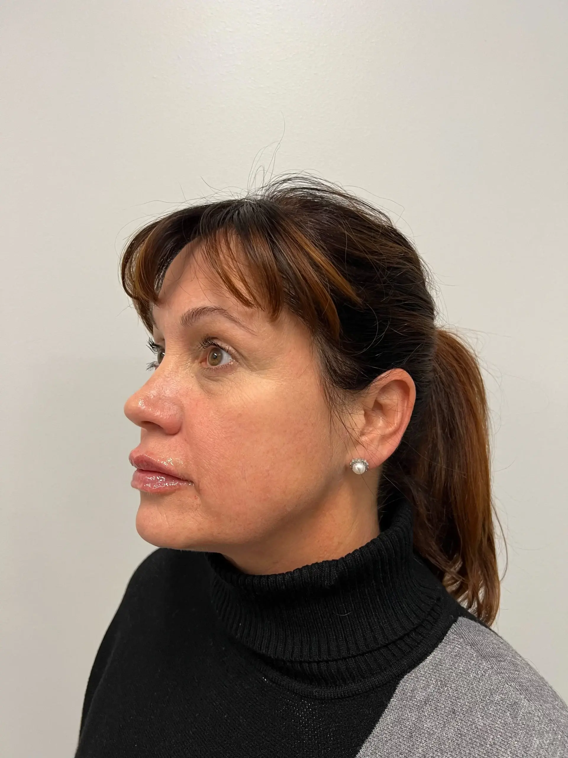 Urban Medspa & Weight Loss Center lip filler after — Charlotte, NC