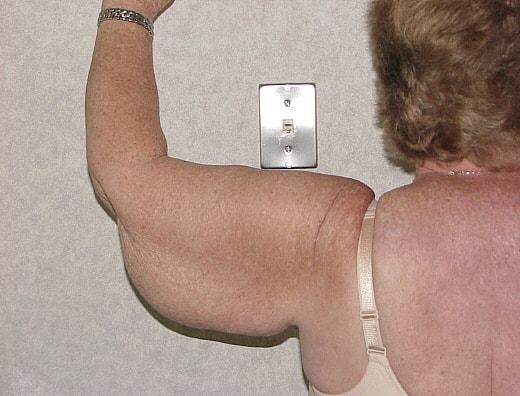 Arm Lift before at Gillian Institute in Indianapolis, IN