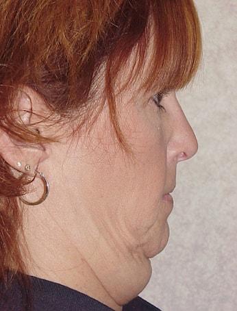 Neck Lift before at Gillian Institute in Indianapolis, IN