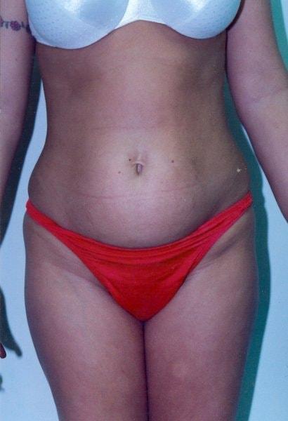 Mini Tummy Tuck before at Gillian Institute in Indianapolis, IN