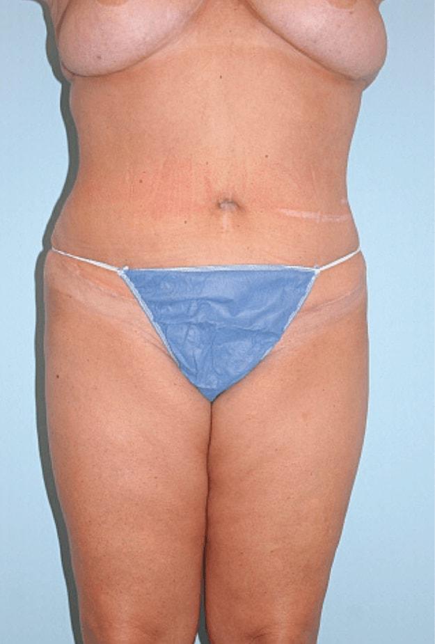 Gillian Institute tummy tuck after — Indianapolis, IN