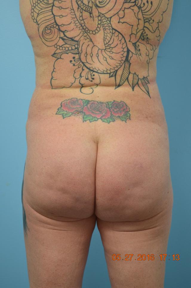 Brazilian Butt Lift after at Gillian Institute in Indianapolis, IN