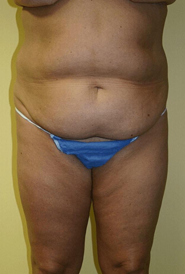 Mini Tummy Tuck before at Gillian Institute in Indianapolis, IN