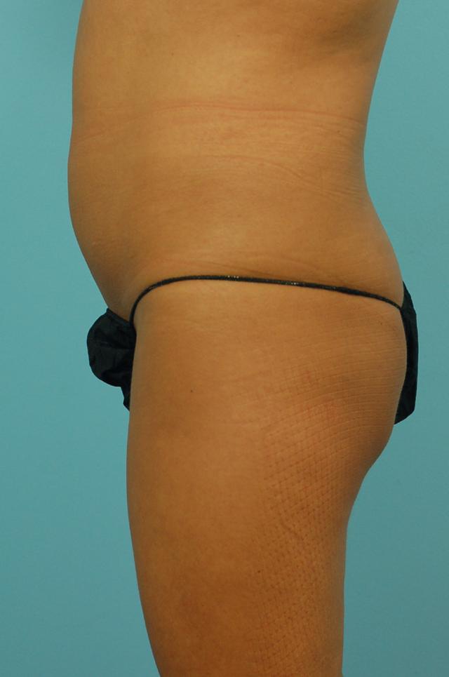 Brazilian Butt Lift before at Gillian Institute in Indianapolis, IN