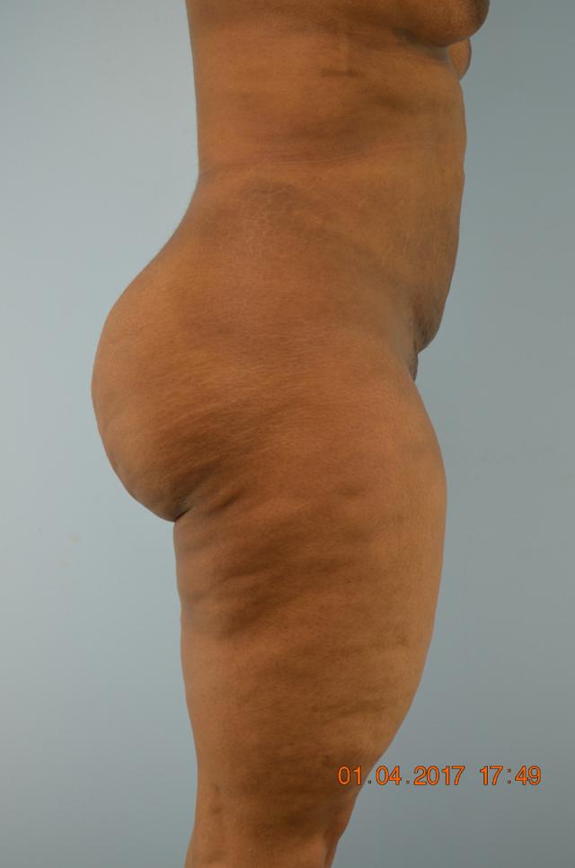 Liposuction after at Gillian Institute in Indianapolis, IN