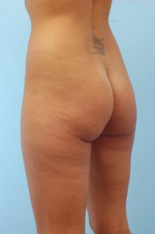 Brazilian Butt Lift before at Gillian Institute in Indianapolis, IN