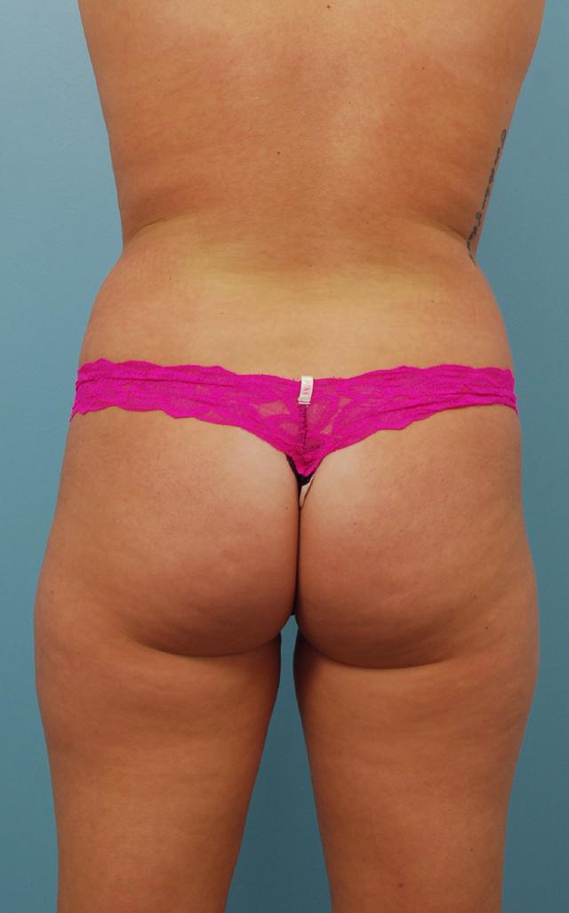 Brazilian Butt Lift before at Gillian Institute in Indianapolis, IN
