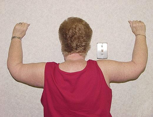 Arm Lift after at Gillian Institute in Indianapolis, IN