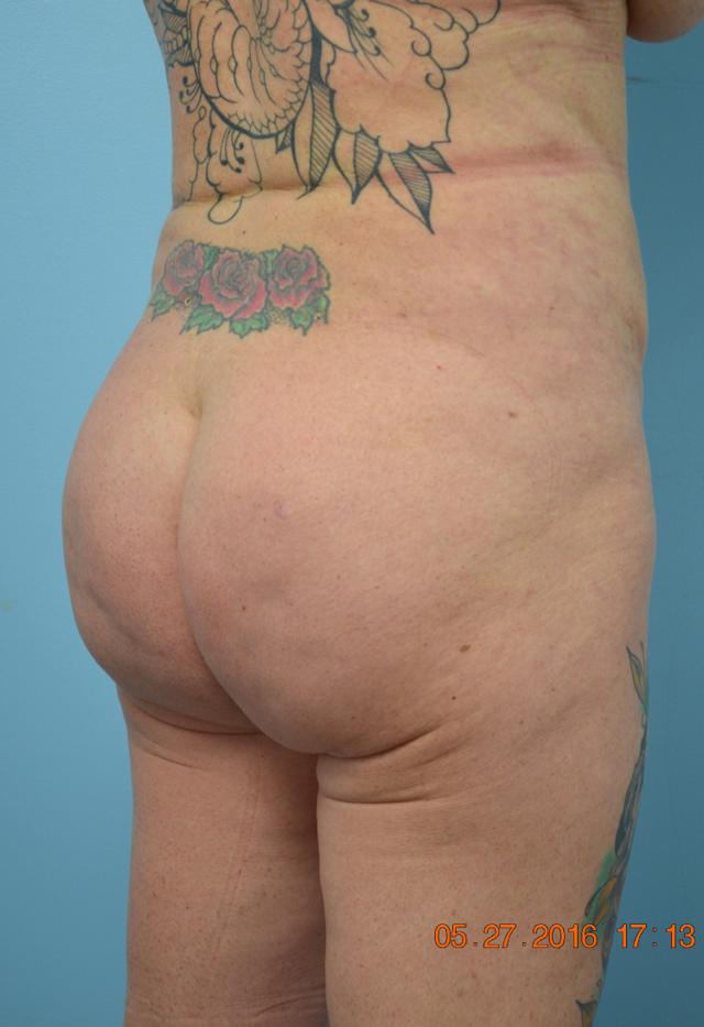 Brazilian Butt Lift after at Gillian Institute in Indianapolis, IN