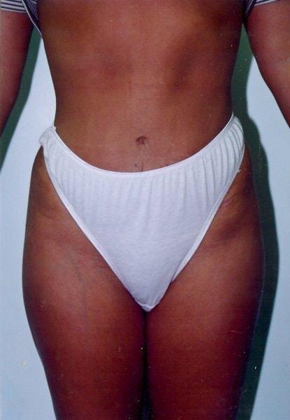 Mini Tummy Tuck after at Gillian Institute in Indianapolis, IN