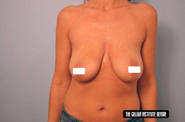 Breast Lift before at Gillian Institute in Indianapolis, IN