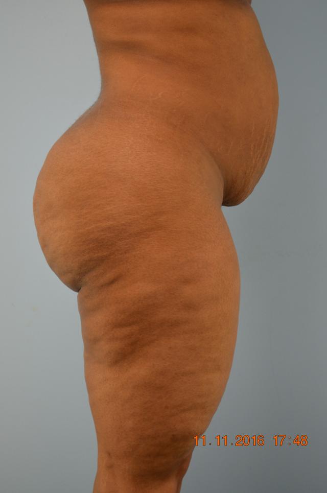 Liposuction before at Gillian Institute in Indianapolis, IN