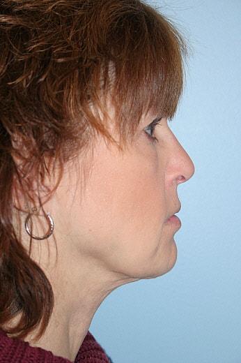 Neck Lift after at Gillian Institute in Indianapolis, IN