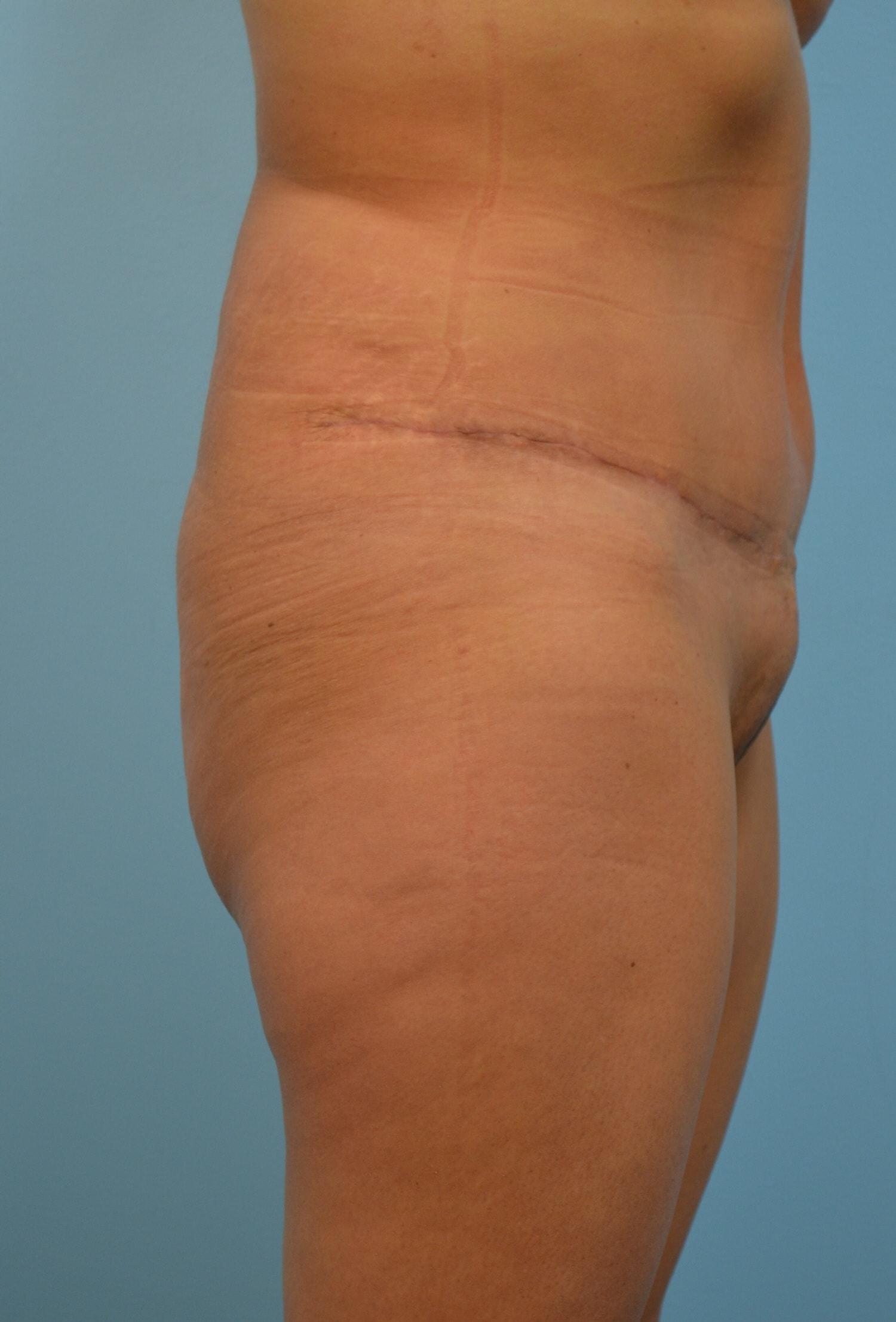 Gillian Institute tummy tuck after — Indianapolis, IN