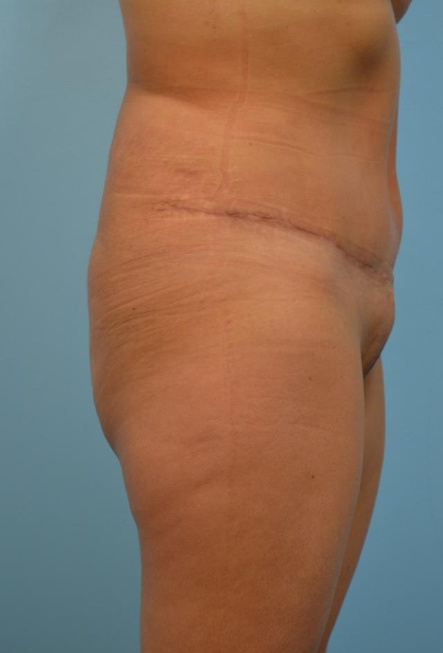 Mini Tummy Tuck after at Gillian Institute in Indianapolis, IN