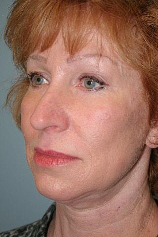 Deep Plane Facelift before at Gillian Institute in Indianapolis, IN