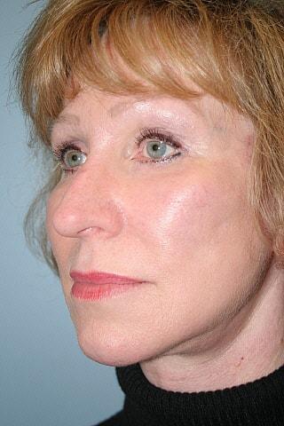 Deep Plane Facelift after at Gillian Institute in Indianapolis, IN