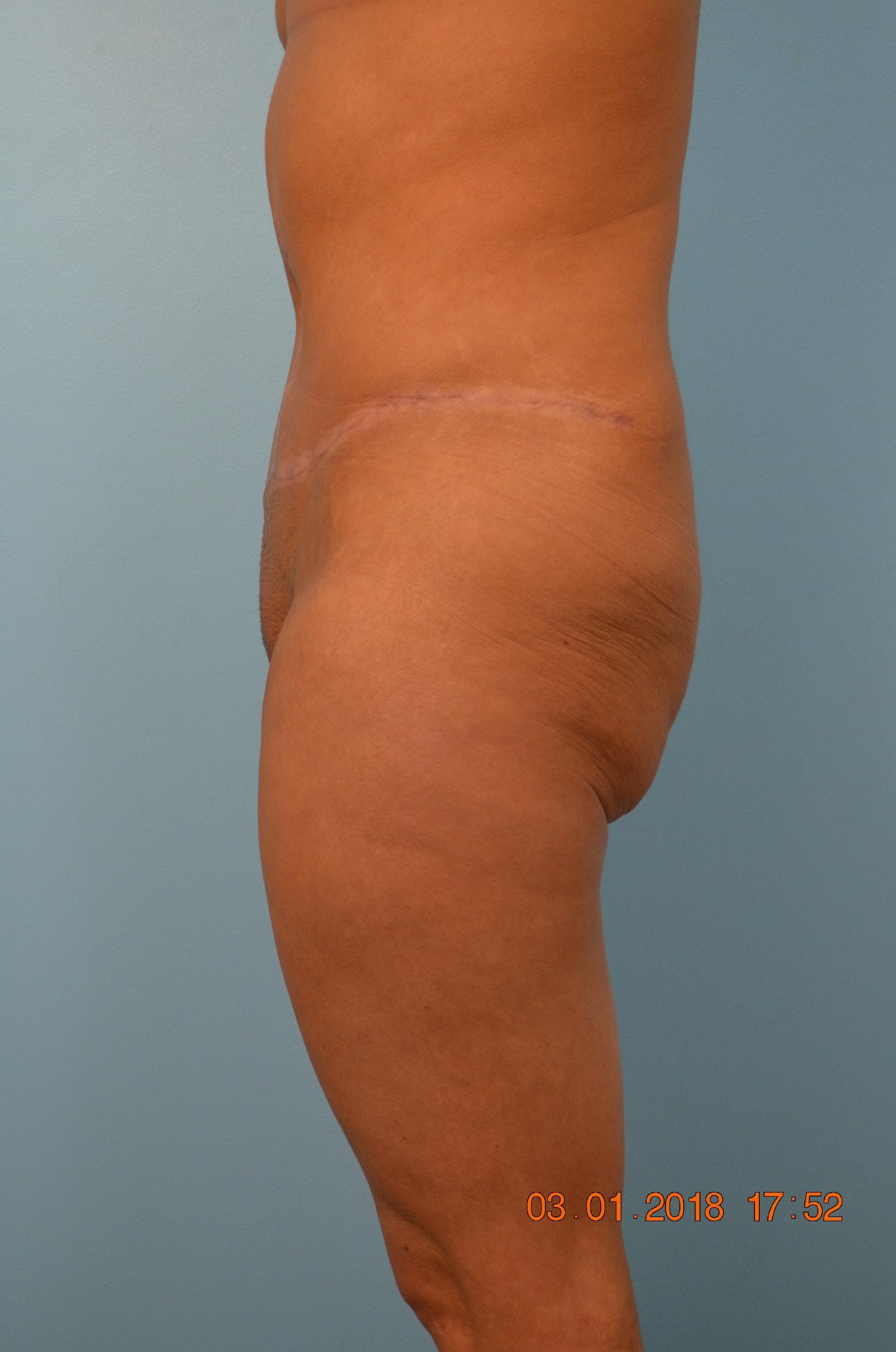 Gillian Institute tummy tuck after — Indianapolis, IN