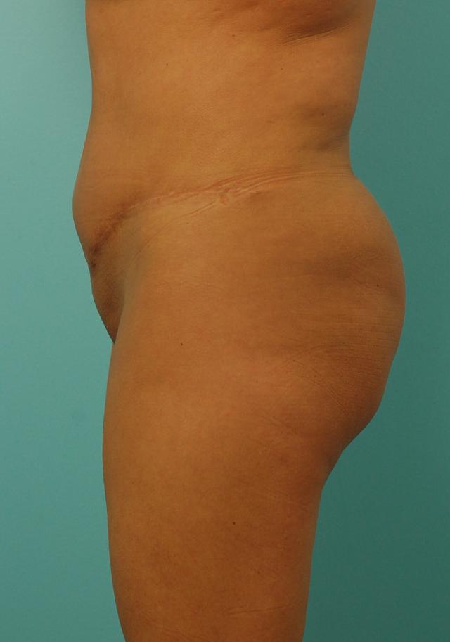 Brazilian Butt Lift after at Gillian Institute in Indianapolis, IN