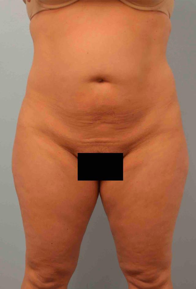 Liposuction before at Gillian Institute in Indianapolis, IN