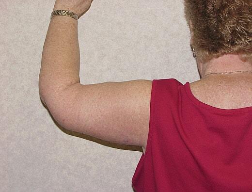 Arm Lift after at Gillian Institute in Indianapolis, IN
