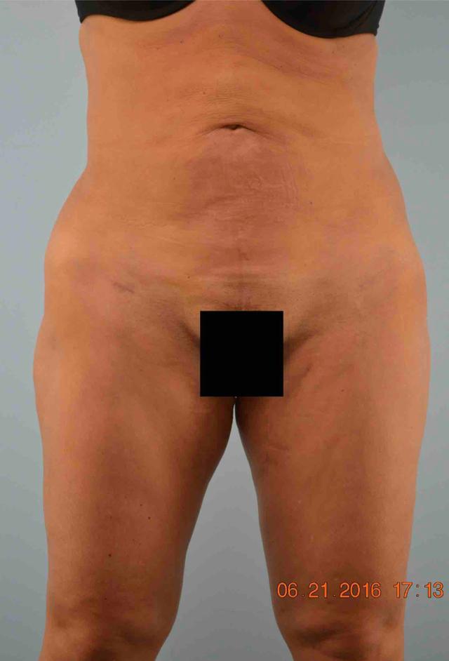 Liposuction after at Gillian Institute in Indianapolis, IN